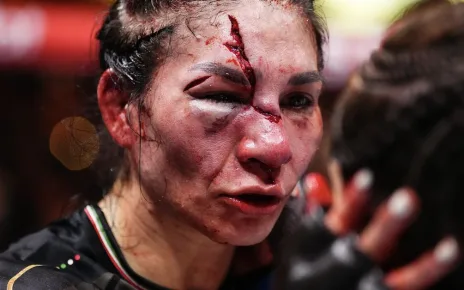 Here’s What Irene Aldana Looks Like Without Stitches Following Awful UFC Noche Face Gash